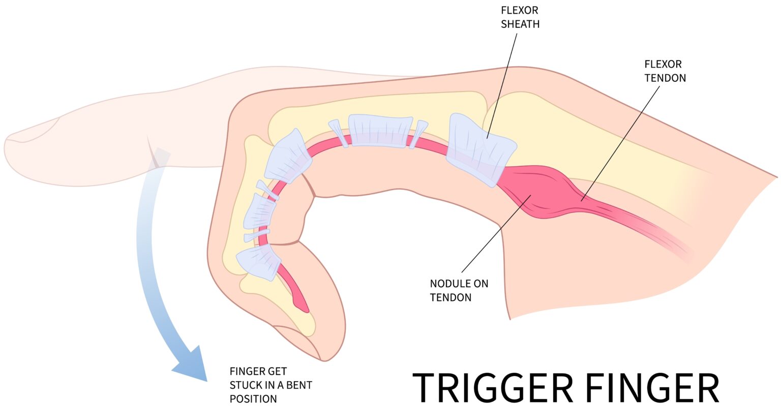 Trigger Finger Node Trigger Finger Birmingham | Hand Surgeon